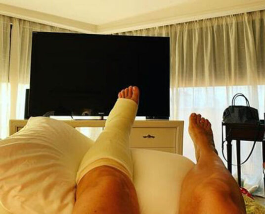 Mara Venier fuori gioco, frattura al piede sinistro