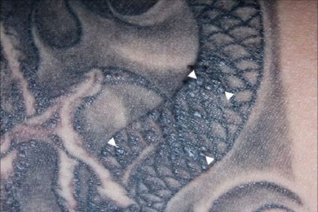 Tatuaggio gli fa perdere l’udito e gli altera la vista: lo strano caso