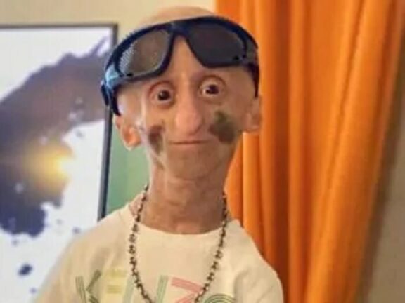 Morta a 16 anni Rania, la star di TikTok affetta da invecchiamento precoce