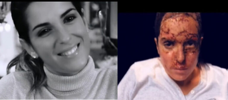 Violenza sulle donne, Gessica Notaro mostra gli sfregi sul volto