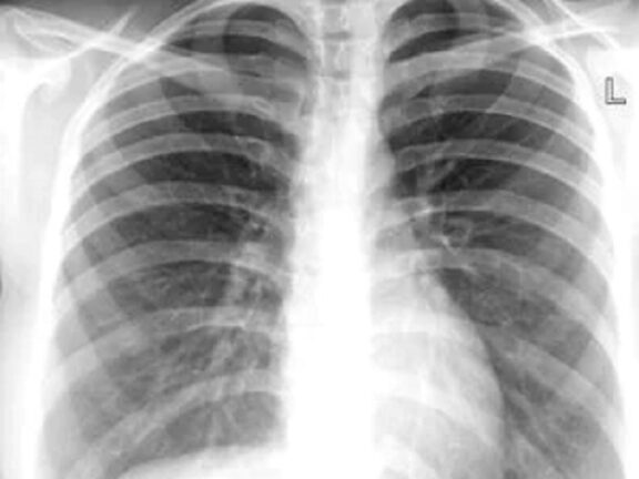 Febbre alta e tosse: ha un preservativo nei polmoni