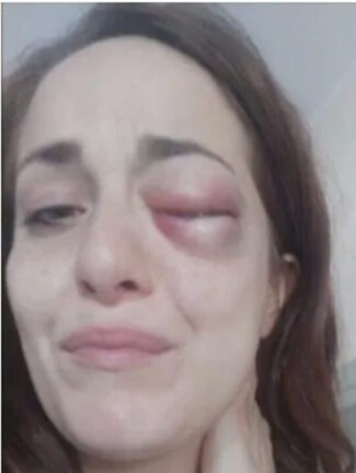 Giuliana Danzé vittima di violenze, mostra il volto tumefatto