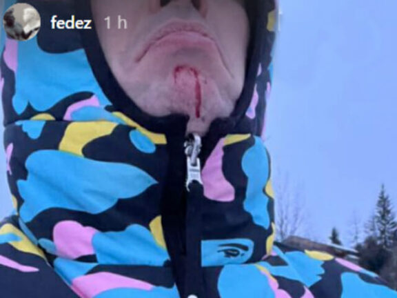 Fedez vittima di un incidente: Mi sono aperto la faccia