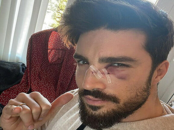 Mariano Di Vaio drammatico incidente volto insanguinato
