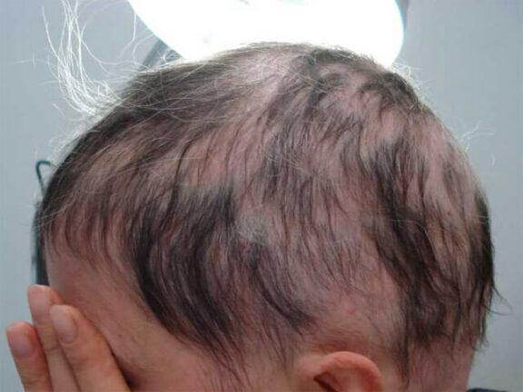 Alopecia: farmaco anti artrite fa ricrescere i capelli