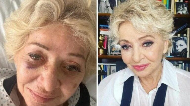 Enrica Bonaccorti puntualizza: “sono caduta dalle scale”