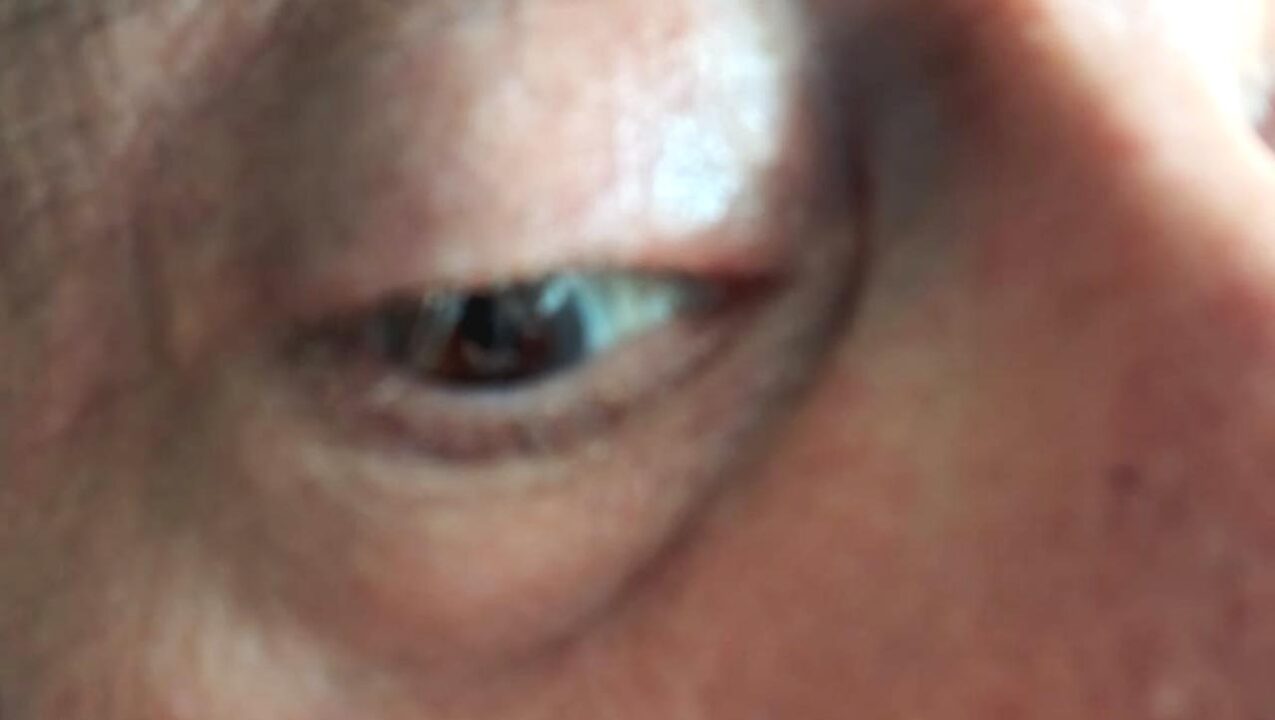 Miracolo della terapia genica: destinato alla cecità, ritorna a vedere