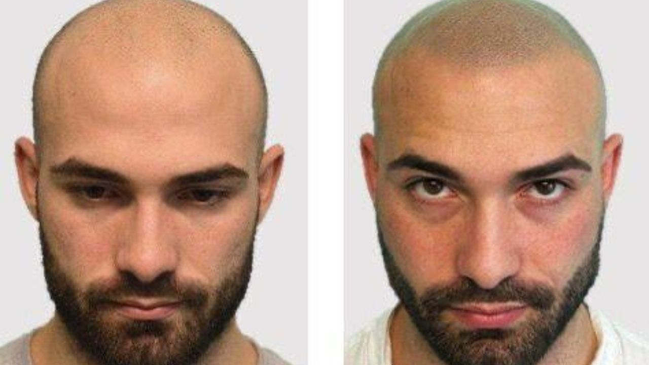 La tricopigmentazione per fronteggiare le calvizie? La risposta di Stefano Pastorini