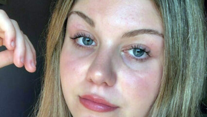 Eleonora Chieregato muore a 17 anni per una malattia autoimmune