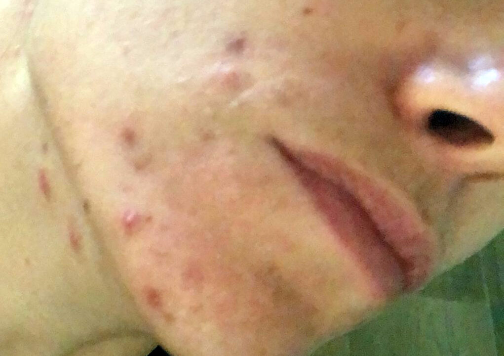 Acne e alimentazione: il binomio vincente per una pelle più pulita