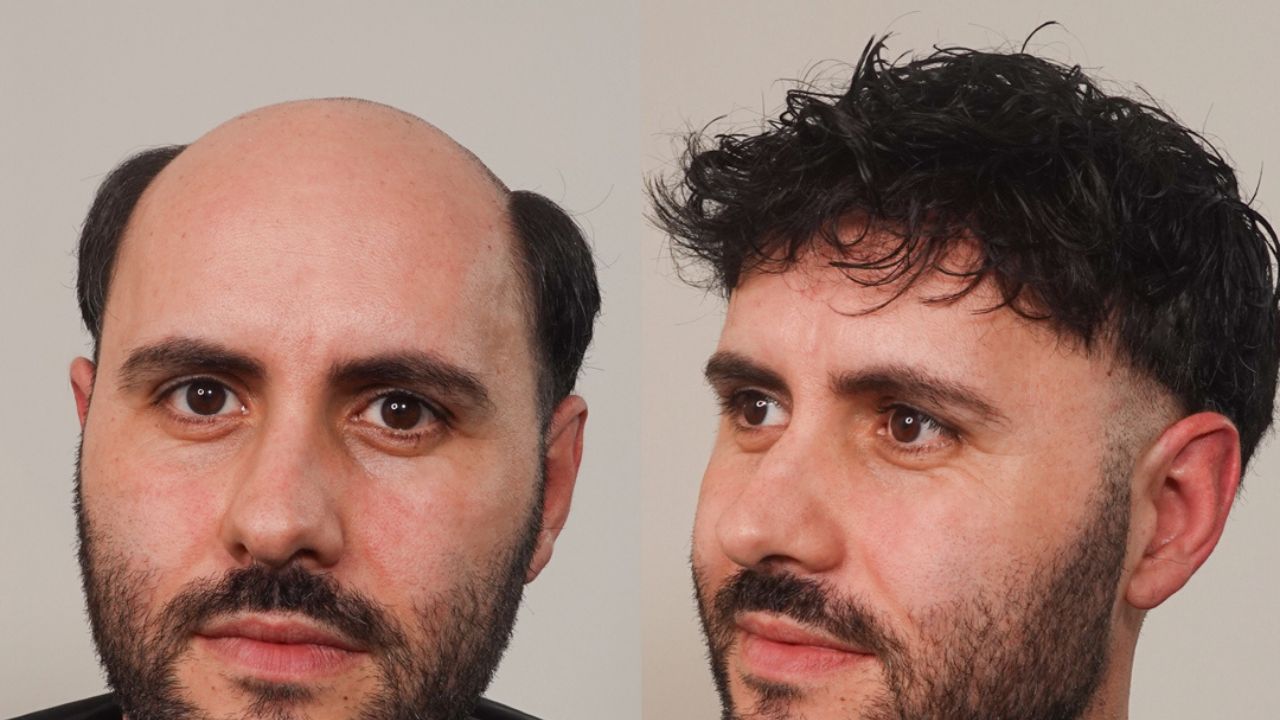 Protesi capelli e patch cutaneo: cosa valutare prima di scegliere una soluzione non chirurgica